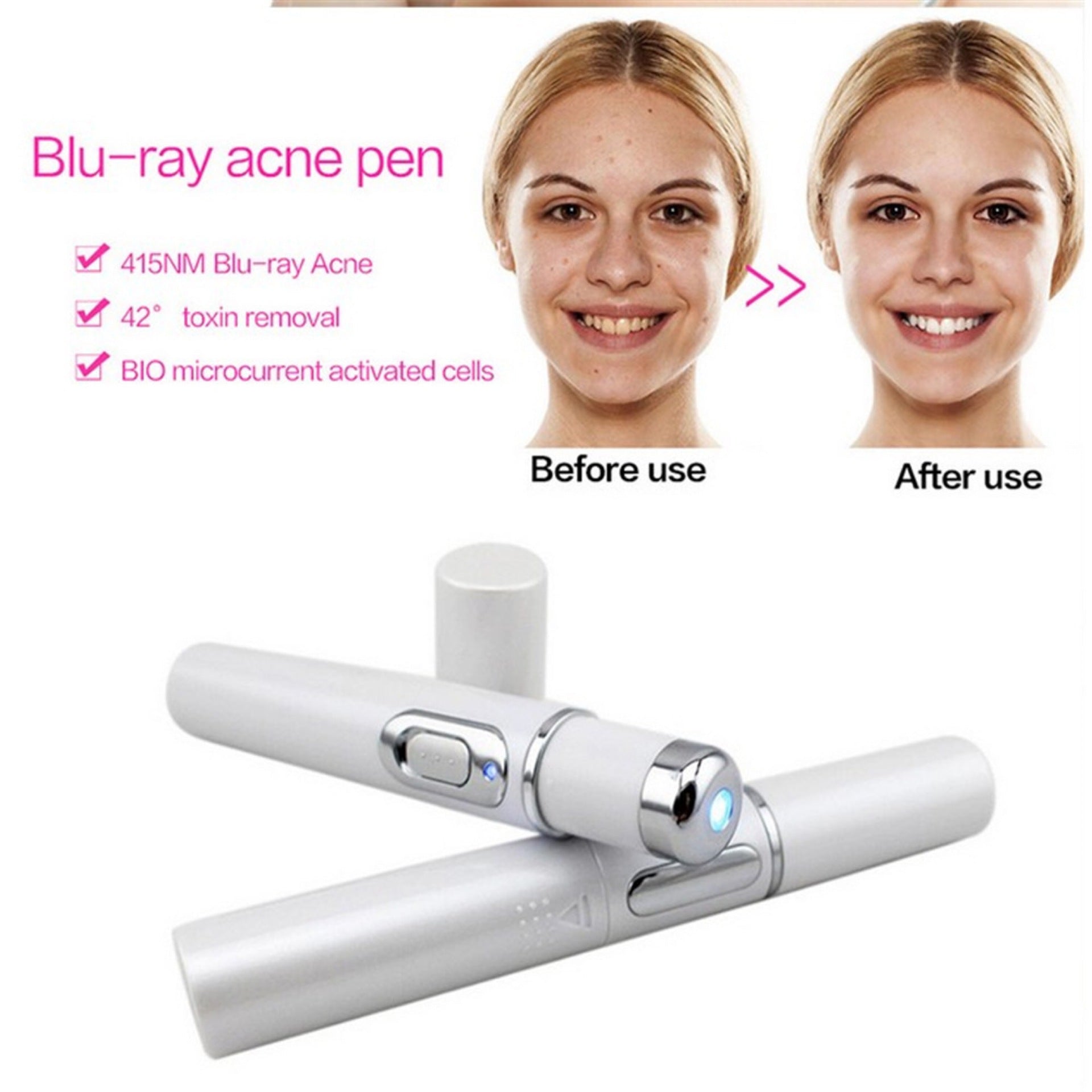 Blue Light Therapy Acne Laser Pen janaila