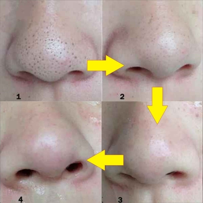 pore strips before and after